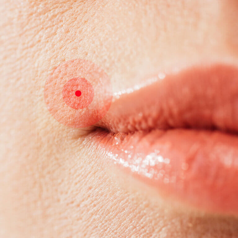 indikation herpes (1)