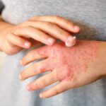 indikation neurodermitis